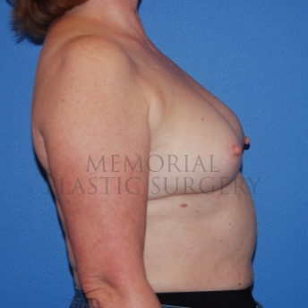 A side view before photo of patient 769 that underwent Latissimus Muscle procedures at Memorial Plastic Surgery