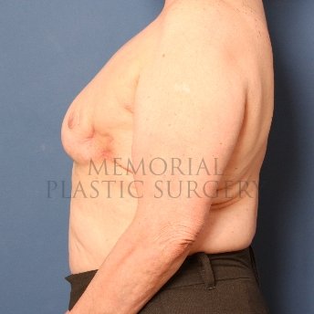 A side view before photo of patient 213 that underwent Latissimus Muscle procedures at Memorial Plastic Surgery