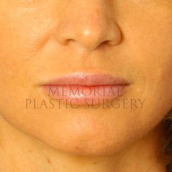 A front view after photo of patient 232 that underwent Lip Augmentation procedures at Memorial Plastic Surgery