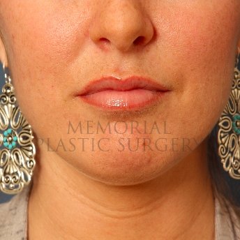 A front view after photo of patient 230 that underwent Lip Augmentation procedures at Memorial Plastic Surgery