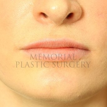 A front view after photo of patient 231 that underwent Lip Augmentation procedures at Memorial Plastic Surgery