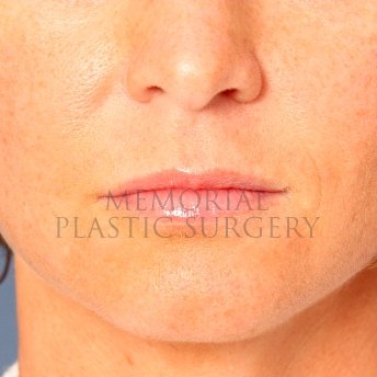 A front view before photo of patient 232 that underwent Lip Augmentation procedures at Memorial Plastic Surgery