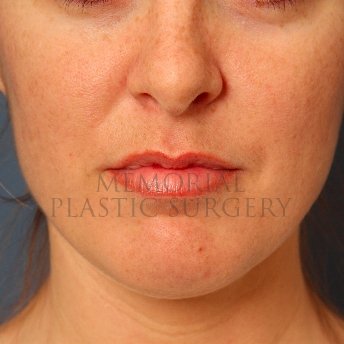 A front view before photo of patient 230 that underwent Lip Augmentation procedures at Memorial Plastic Surgery
