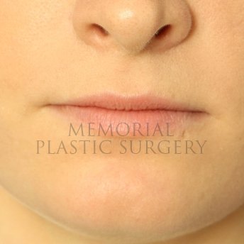 A front view before photo of patient 231 that underwent Lip Augmentation procedures at Memorial Plastic Surgery