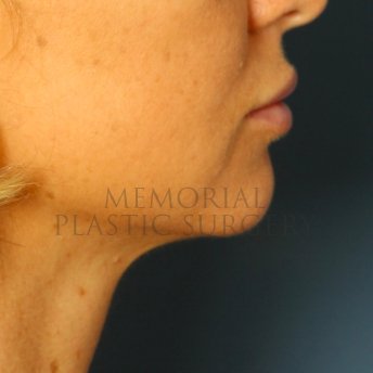 A oblique view after photo of patient 232 that underwent Lip Augmentation procedures at Memorial Plastic Surgery