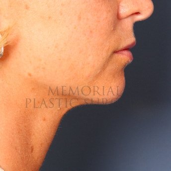 A oblique view before photo of patient 232 that underwent Lip Augmentation procedures at Memorial Plastic Surgery