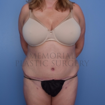 A front view after photo of patient 696 that underwent Liposuction:Abdominoplasty Tummy Tuck procedures at Memorial Plastic Surgery