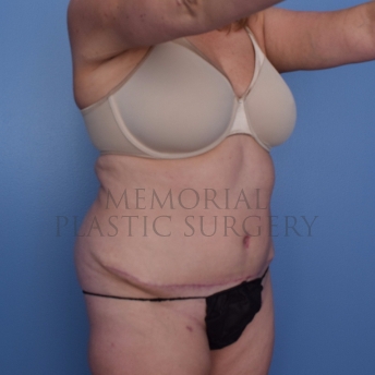A oblique view after photo of patient 696 that underwent Liposuction:Abdominoplasty Tummy Tuck procedures at Memorial Plastic Surgery