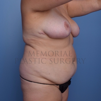 A oblique view before photo of patient 696 that underwent Liposuction:Abdominoplasty Tummy Tuck procedures at Memorial Plastic Surgery