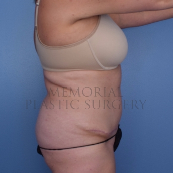 A side view after photo of patient 696 that underwent Liposuction:Abdominoplasty Tummy Tuck procedures at Memorial Plastic Surgery