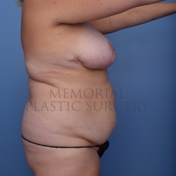 A side view before photo of patient 696 that underwent Liposuction:Abdominoplasty Tummy Tuck procedures at Memorial Plastic Surgery