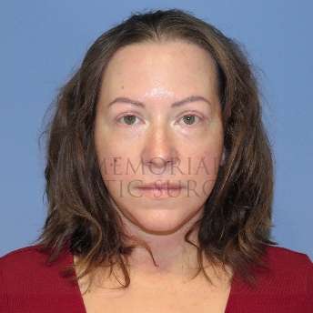 A front view after photo of patient 4122 that underwent Liposuction:Blepharoplasty:NeckLift:Face Lift procedures at Memorial Plastic Surgery