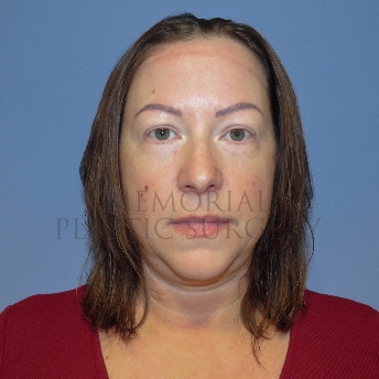 A front view before photo of patient 4122 that underwent Liposuction:Blepharoplasty:NeckLift:Face Lift procedures at Memorial Plastic Surgery