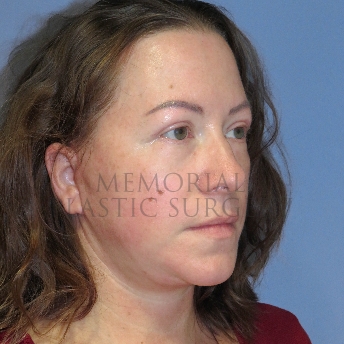 A oblique view after photo of patient 4122 that underwent Liposuction:Blepharoplasty:NeckLift:Face Lift procedures at Memorial Plastic Surgery