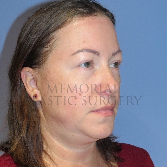 A oblique view before photo of patient 4122 that underwent Liposuction:Blepharoplasty:NeckLift:Face Lift procedures at Memorial Plastic Surgery