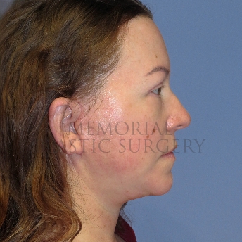 A side view after photo of patient 4122 that underwent Liposuction:Blepharoplasty:NeckLift:Face Lift procedures at Memorial Plastic Surgery