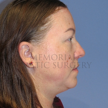 A side view before photo of patient 4122 that underwent Liposuction:Blepharoplasty:NeckLift:Face Lift procedures at Memorial Plastic Surgery
