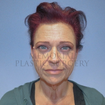 A front view before photo of patient 4123 that underwent Liposuction:Face Lift:NeckLift procedures at Memorial Plastic Surgery