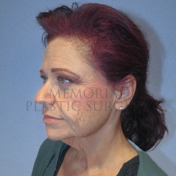 A oblique view before photo of patient 4123 that underwent Liposuction:Face Lift:NeckLift procedures at Memorial Plastic Surgery