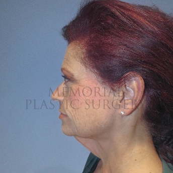 A side view before photo of patient 4123 that underwent Liposuction:Face Lift:NeckLift procedures at Memorial Plastic Surgery