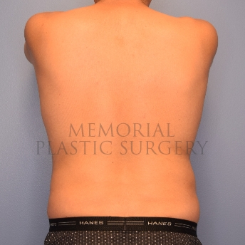 A back view after photo of patient 2221 that underwent Liposuction procedures at Memorial Plastic Surgery