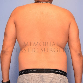 A back view before photo of patient 2221 that underwent Liposuction procedures at Memorial Plastic Surgery