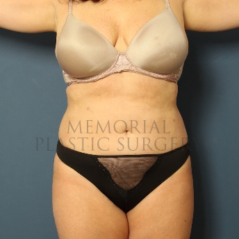 A front view after photo of patient 387 that underwent Liposuction procedures at Memorial Plastic Surgery