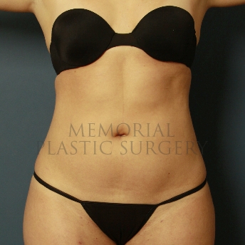 A front view after photo of patient 386 that underwent Liposuction procedures at Memorial Plastic Surgery