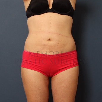 A front view after photo of patient 363 that underwent Liposuction procedures at Memorial Plastic Surgery
