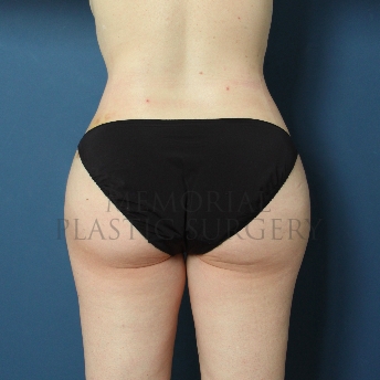 A front view after photo of patient 276 that underwent Liposuction procedures at Memorial Plastic Surgery