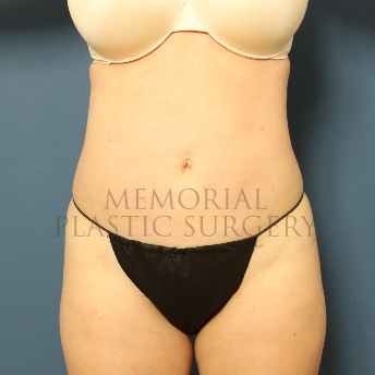 A front view after photo of patient 305 that underwent Liposuction procedures at Memorial Plastic Surgery