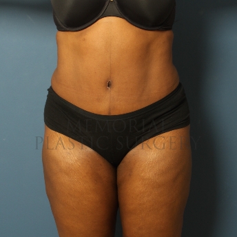 A front view after photo of patient 371 that underwent Liposuction procedures at Memorial Plastic Surgery
