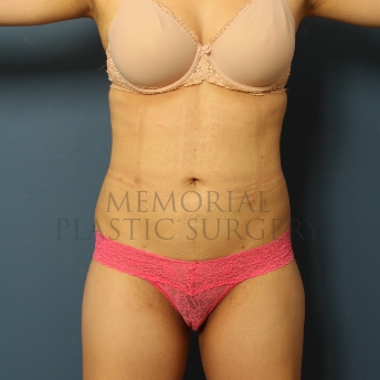 A front view after photo of patient 316 that underwent Liposuction procedures at Memorial Plastic Surgery