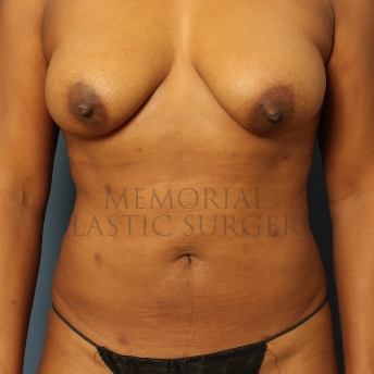 A front view after photo of patient 351 that underwent Liposuction procedures at Memorial Plastic Surgery