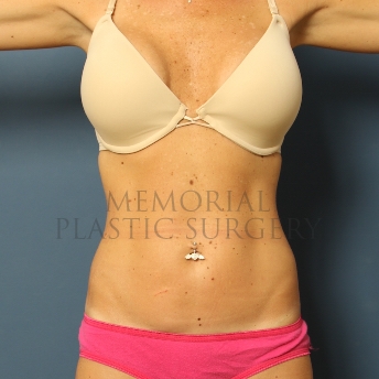 A front view after photo of patient 353 that underwent Liposuction procedures at Memorial Plastic Surgery