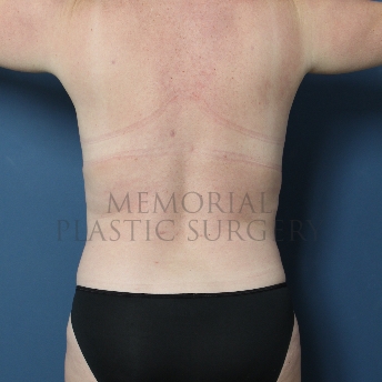 A front view after photo of patient 373 that underwent Liposuction procedures at Memorial Plastic Surgery