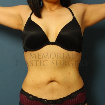 A front view after photo of patient 341 that underwent Liposuction procedures at Memorial Plastic Surgery