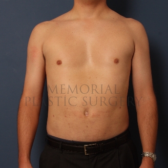 A front view after photo of patient 388 that underwent Liposuction procedures at Memorial Plastic Surgery
