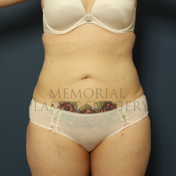 A front view after photo of patient 309 that underwent Liposuction procedures at Memorial Plastic Surgery