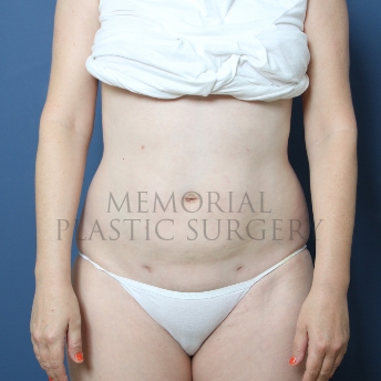 A front view after photo of patient 301 that underwent Liposuction procedures at Memorial Plastic Surgery