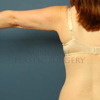 A front view after photo of patient 356 that underwent Liposuction procedures at Memorial Plastic Surgery