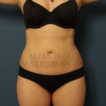 A front view after photo of patient 375 that underwent Liposuction procedures at Memorial Plastic Surgery
