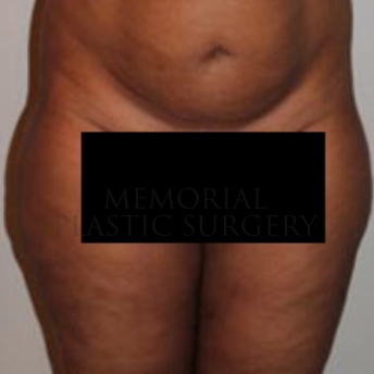 A front view after photo of patient 174 that underwent Liposuction procedures at Memorial Plastic Surgery