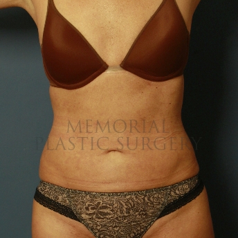 A front view after photo of patient 389 that underwent Liposuction procedures at Memorial Plastic Surgery