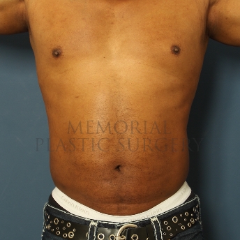 A front view after photo of patient 345 that underwent Liposuction procedures at Memorial Plastic Surgery