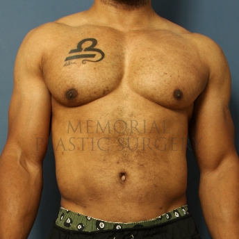 A front view after photo of patient 337 that underwent Liposuction procedures at Memorial Plastic Surgery