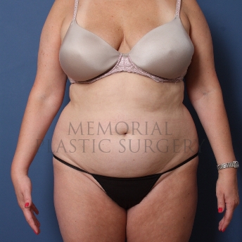A front view before photo of patient 387 that underwent Liposuction procedures at Memorial Plastic Surgery