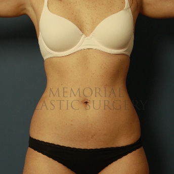 A front view before photo of patient 360 that underwent Liposuction procedures at Memorial Plastic Surgery