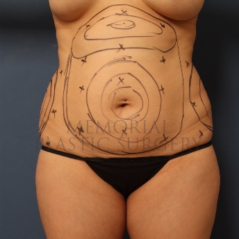 A front view before photo of patient 334 that underwent Liposuction procedures at Memorial Plastic Surgery