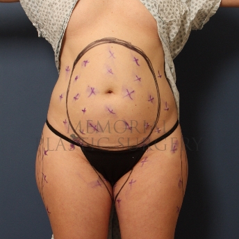 A front view before photo of patient 363 that underwent Liposuction procedures at Memorial Plastic Surgery